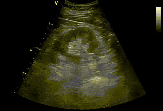 Kidney ultrasound