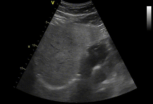 Liver ultrasound