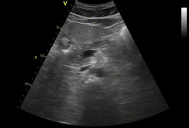 Pancreas ultrasound