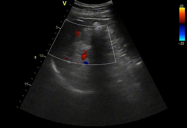 Spleen ultrasound